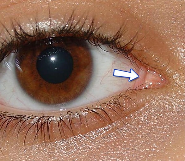 9. Полулунная складка конъюнктивы