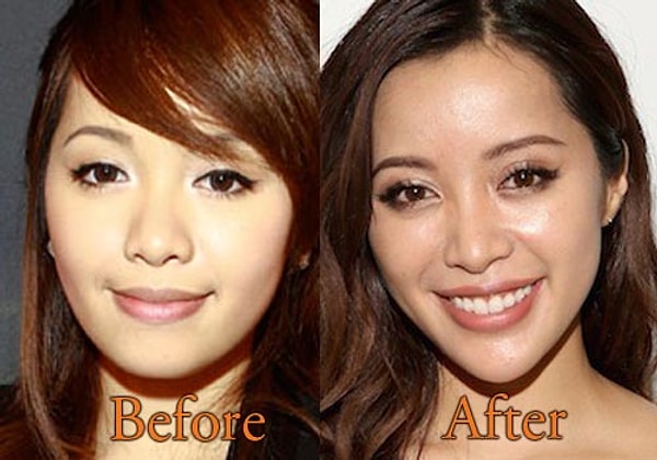 Популярная процедура последних лет - филлеры скул