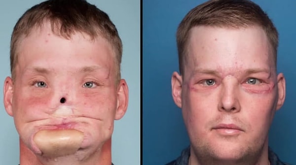 2. Однако получилось так, что не только эти органы сгодились на доброе дело: лицо Калена идеально подошло Энди, который ждал трансплантации уже 10 лет.