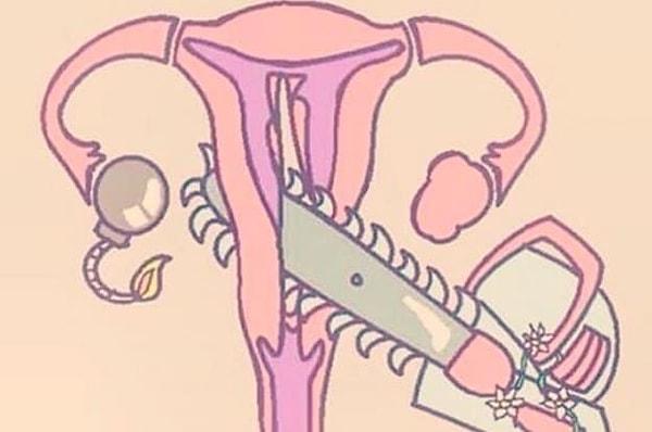 8. Başlıca sebepler arasında sinir hasarı, vulvadaki sinir liflerinde artış ve yine vulvadaki iltihabın yükselmesi yer alıyor.