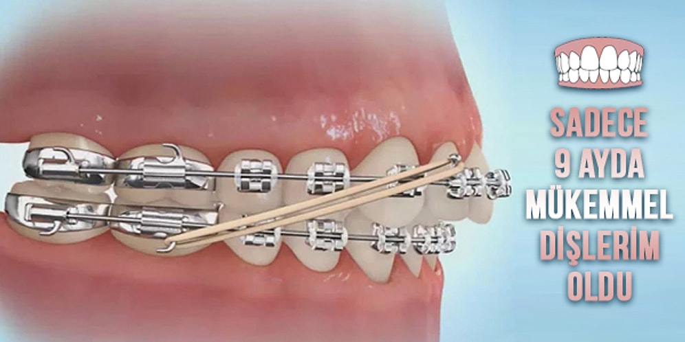 Diş Teli Taktırmayı Düşünenler İçin Baştan Sona Tüm Yönleriyle Diş Teli Takma Deneyimim
