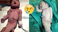 Hindistan'da Dünyaya Gelen 'Deniz Kızı Sendromlu Bebek' Dört Saat Sonra Hayatını Kaybetti!