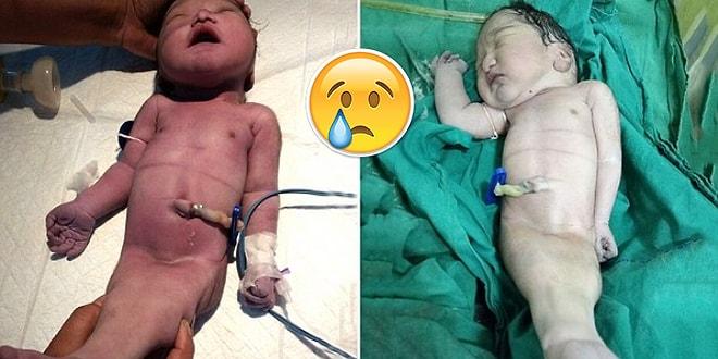 Hindistan'da Dünyaya Gelen 'Deniz Kızı Sendromlu Bebek' Dört Saat Sonra Hayatını Kaybetti!