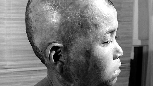 6. Японский мальчик, выживший после падения ядерной бомбы