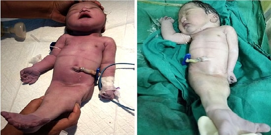Ребенок, появившийся на свет в Индии с синдромом русалки, умер через 4 часа после рождения