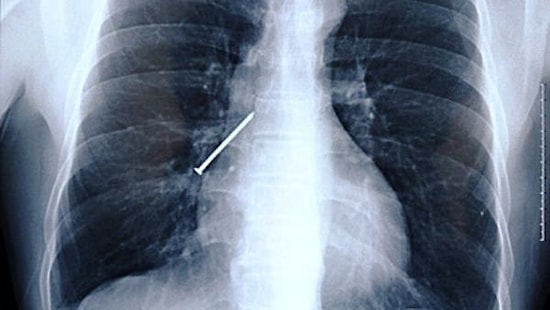 Удивительное рядом: 14 самых неожиданных вещей, найденных у пациентов при рентгене