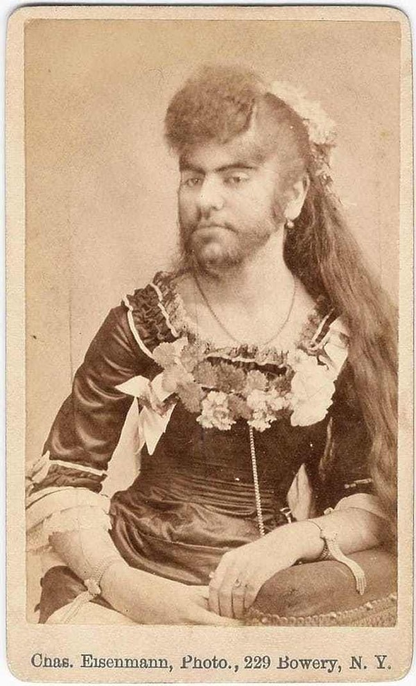 2. Основная причина гирсутизма — гормональный дисбаланс