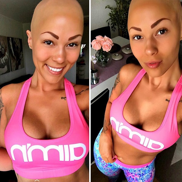 Терезе сейчас 26 лет, и она сейчас пытается подбадривать тех, кто борется с алопецией.