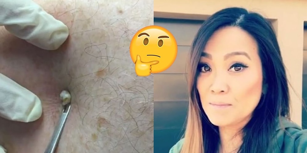 Artık Televizyonlarda İrin de Göreceğiz: YouTube Fenomeni Dr. Pimple Popper Televizyon Programına Başlıyor!