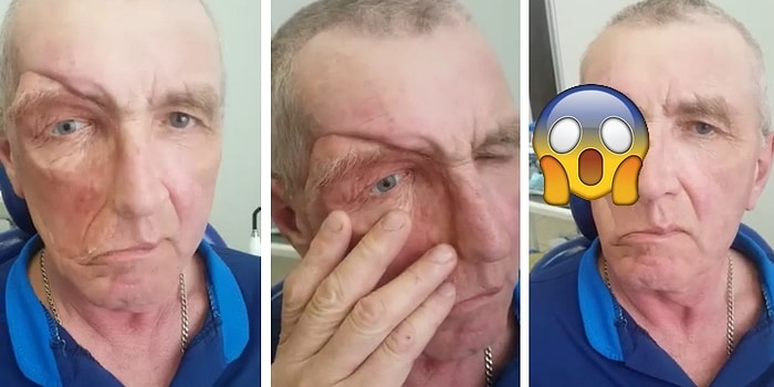 Görenleri Hayrete Düşüren Protez Yüzlü Adam