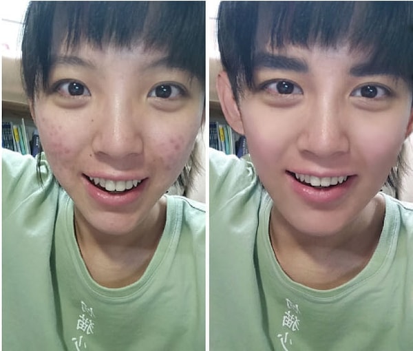 10. Прыщи? Не, не слышали