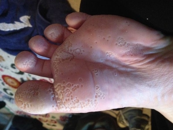 2. Когда трипофобия встречается с подофобией