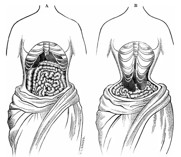 3. Корсеты были настолько плотно зашнурованы, что просто разрезали женщин пополам.