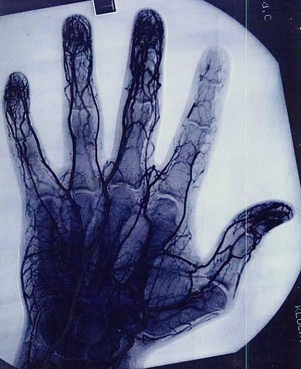 14. Bu anjiyografi görselleri bir yoyo ustasının işaret parmağının damarlarındaki hasarı gösteriyor.
