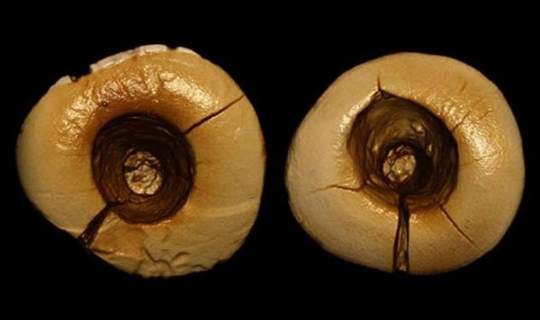 3. Лечение зубов современными методами