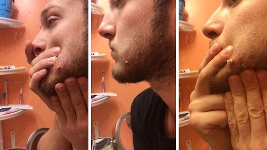 Suratındaki Kisti Sıkarak İçinden Dünyaları Çıkartan Adam