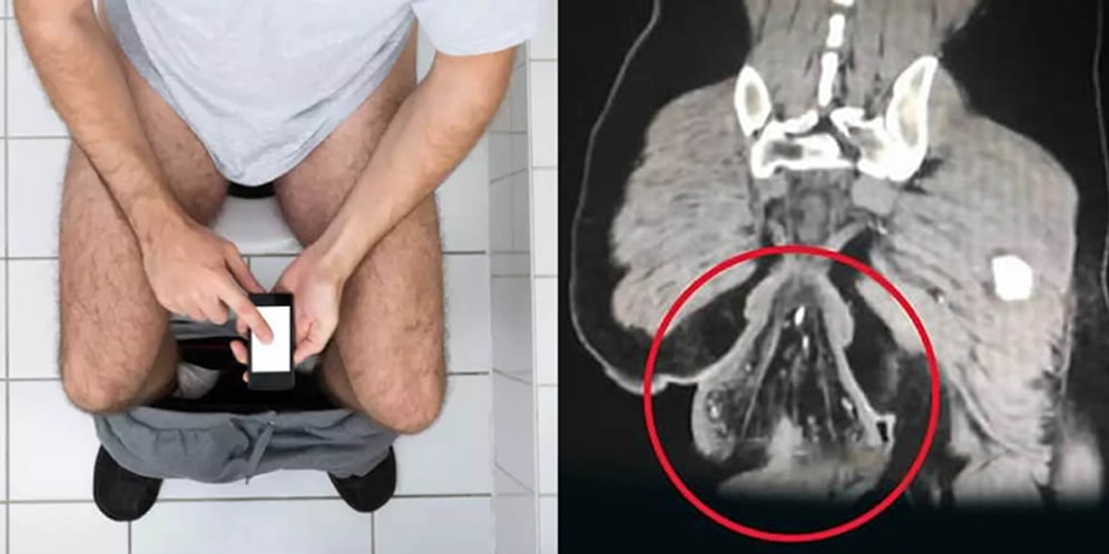 Oyuna Dalarak Tuvalette 30 Dakikadan Fazla Kalan Çinli Adamın Hazin Sonu: Makat Sarkması!