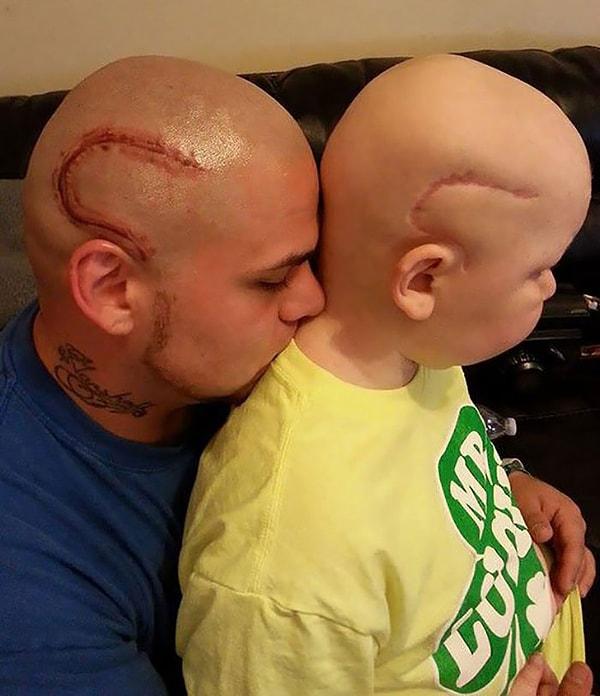 4. Bu kanser ameliyatından geri kalan izi, oğlunun tek başına yüklenmesini istemeyen baba.
