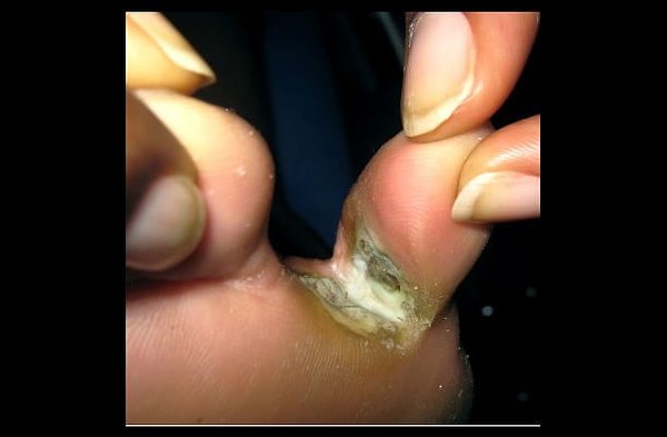 7. Нагноение между пальцами