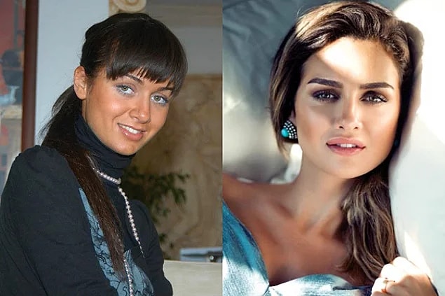 Birce Akalay'ın estetiksiz ve estetikli hali sonuç olarak bu şekilde. 👇