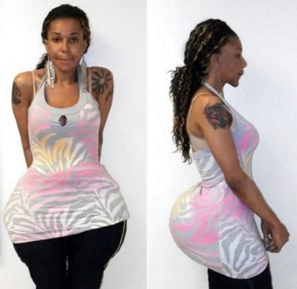 5. Неизвестная с имплантатами для ягодиц из герметика для шин