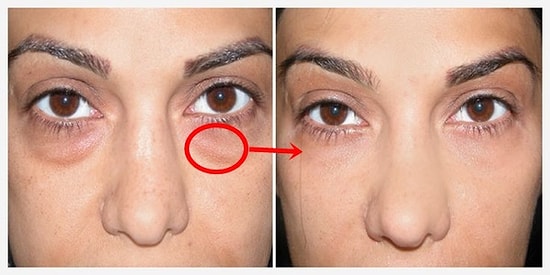 Göz Altı Torbalarına Elveda! Sürekli Şişen Gözlerinizi Daha Güzel Gösterecek 13 Mükemmel Tavsiye