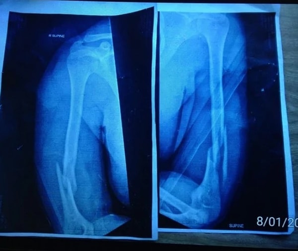 19. "Сломал две руки, занимаясь дельтапланеризмом"