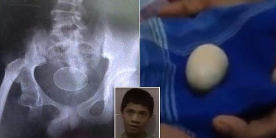 Индонезийский мальчик, вот уже два года якобы регулярно несущий яйца, шокировал врачей!