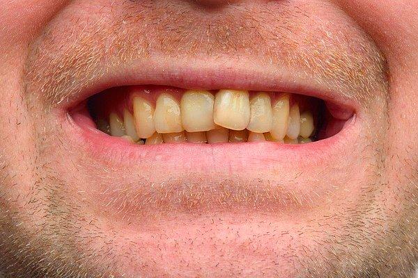 10. Ağız ve diş sağlığınıza gereken özeni göstermeyin ve mümkünse dişlerinizin sararmasını sağlayın.