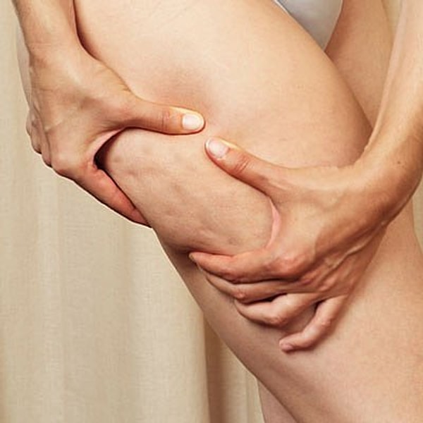 8. Можно быть очень худой, но при этом иметь целлюлит