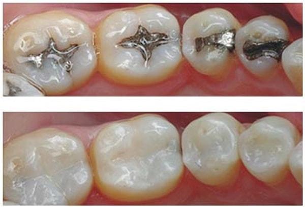Diş hekimleri çürükleri temizleyerek dişleri amalgam (metal dolgu) veya kompozit (diş renginde dolgu) ile dolduruyorlar.