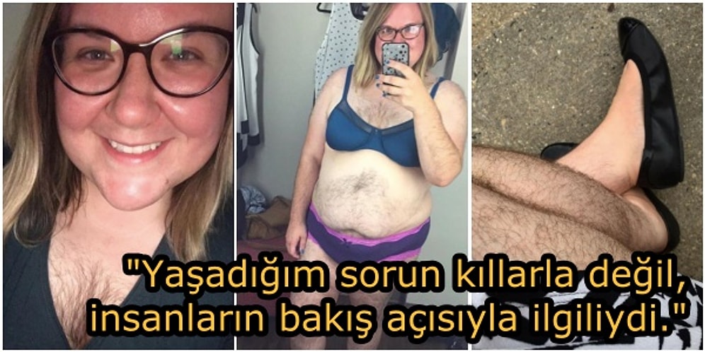 Yıllarca Utandığı Aşırı Kıllı Vücuduyla Barışıp, Sürekli Tıraş Olmaktan Vazgeçen Kadın!