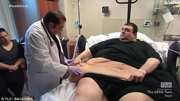 41 yaşındaki Robert Buchel'in kilosu ameliyattan önce 381 kiloya ulaşmıştı.