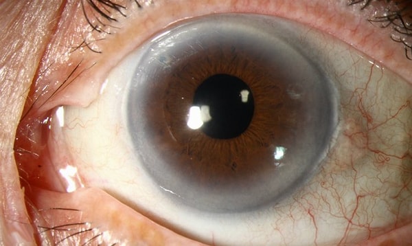 5. Серое кольцо вокруг края роговицы указывает на высокий уровень холестерина в крови.