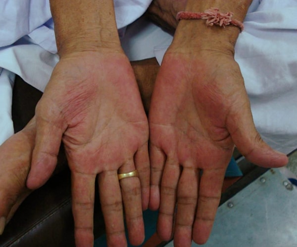 5. Покраснение ладоней.