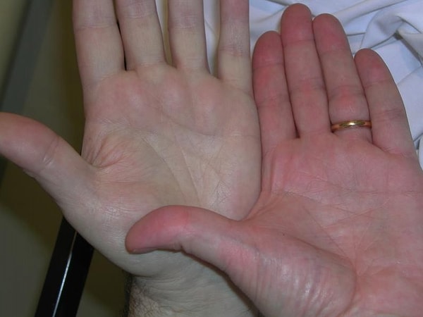 10. Бледность кожных покровов, часто - с умеренной желтизной.