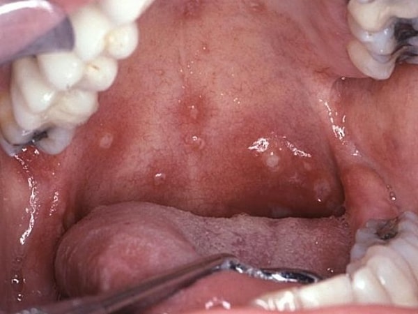 9. Высыпания в полости рта в виде пузырьков с жидкостью.