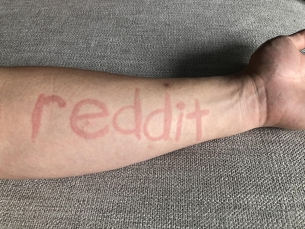 20. У одного из пользователей Reddit дермографизм — заболевание кожи, при котором она реагирует на незначительные механические воздействия, в результате которых появляются красные или белые полосы