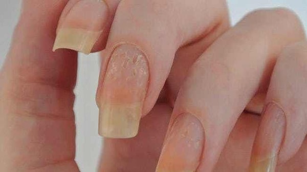 3. Точечные углубления на ногтях могут говорить об артрите