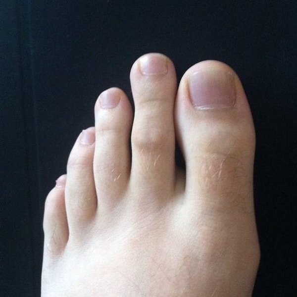 7. Из-за длинного второго пальца возникают проблемы со стопой