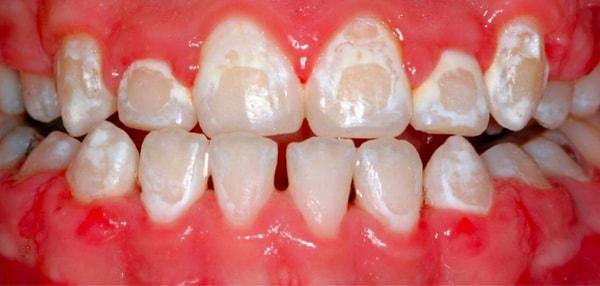 Bu mevzuya diş fluorozu deniyor. Genetik ya da doğuştan gelen bir özellik değil, sonradan edinilen bir durum.