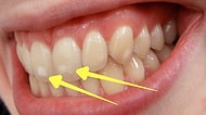 Bunu Hep Merak Ettiğinizi Şimdi Fark Edeceksiniz: Neden Bazı İnsanların Dişlerinde Beyaz Lekeler Vardır?