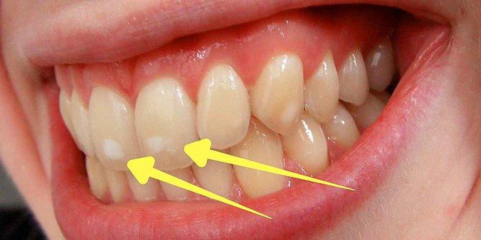 Bunu Hep Merak Ettiğinizi Şimdi Fark Edeceksiniz: Neden Bazı İnsanların Dişlerinde Beyaz Lekeler Vardır?