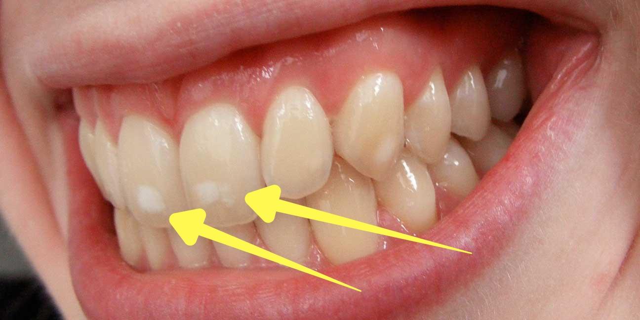 Bunu Hep Merak Ettiğinizi Şimdi Fark Edeceksiniz: Neden Bazı İnsanların Dişlerinde  Beyaz Lekeler Vardır?