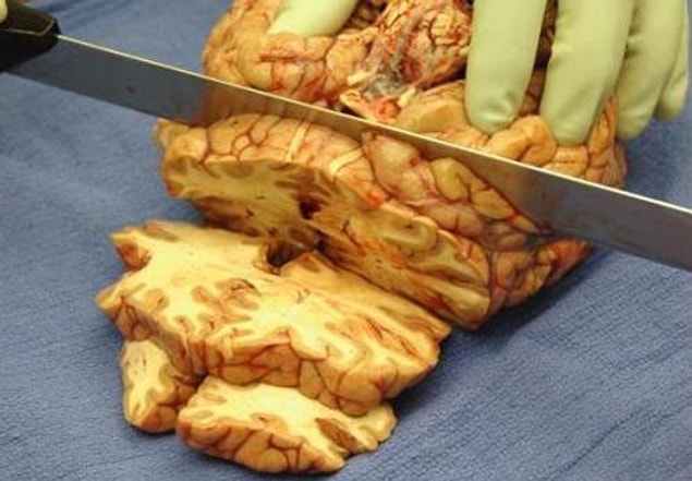 14. Beyinde bilginin ilerleyiş hızı saatte 430 kilometreyi bulabilir. Bu en hızlı F1 yarış aracından bile hızlıdır.