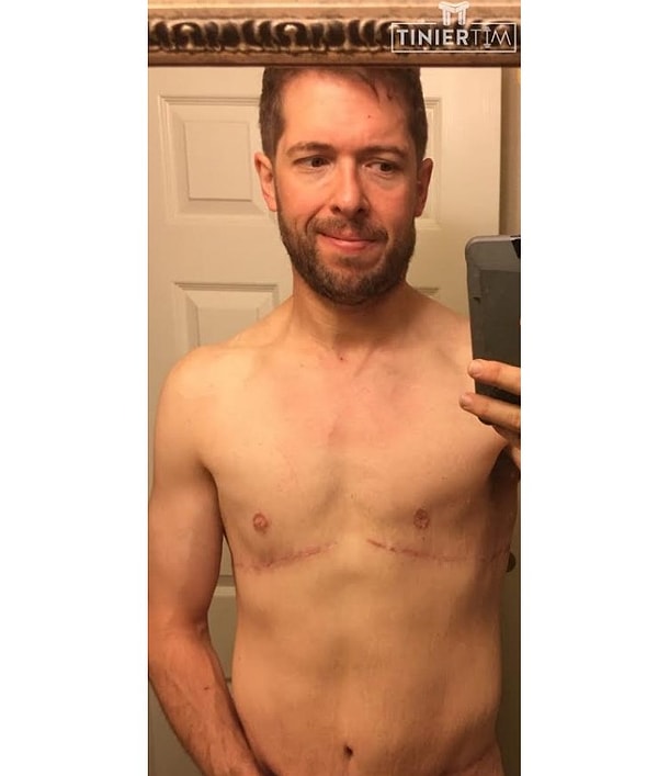 А вот он после операции. На сегодняшний день мужчина активно пропагандирует здоровый образ жизни и вдохновляет людей, страдающих ожирением, начать худеть.