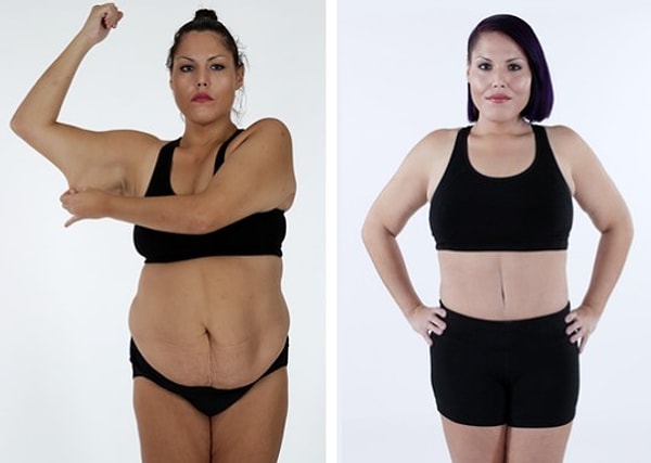 После того как Ялене удалили 11 кг лишней кожи, она наконец смогла почувствовать себя красивой.