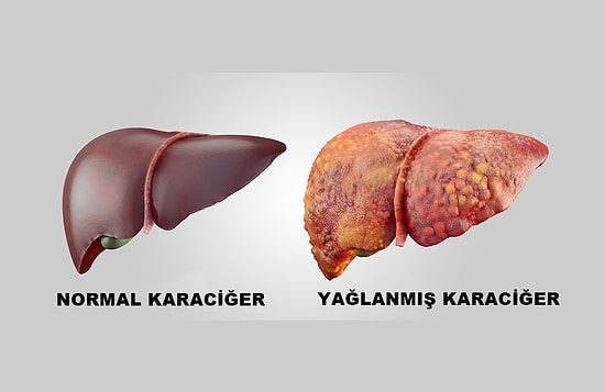 İçten İçe Bizi Öldürebilen Bir Tehlike: Karaciğer Yağlanması ve Korunma Yolları!