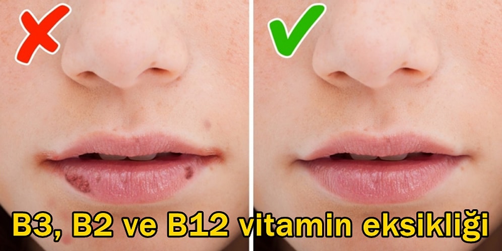 Göz Ardı Etmeyin! Vücudunuzun 'Vitaminim Bitti!' Diye Çığlık Attığını Gösteren 8 İşaret