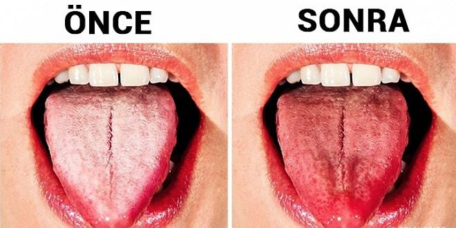 Diliniz Beyaz mı? İşte Bundan Kurtularak Daha Sağlıklı Bir Dile Sahip Olmanın Yolları